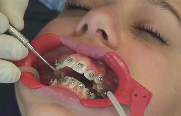 Sống khỏe 360 -  Có nên để trẻ mọc hết răng rồi mới niềng răng 12-01-2020